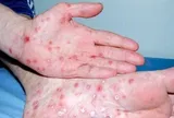 Thông tin nổi bật tại TPHCM ngày 4-5: Người mắc bệnh giang mai tăng; mở rộng đường Trần Bình Trọng