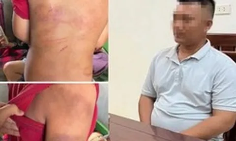 Vụ bé trai 10 tuổi người thâm tím nghi bị bạo hành: Lời khai của bố đẻ