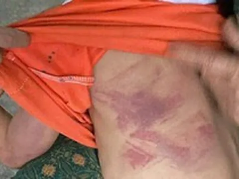 Bé gái lớp 2 bị bạn cùng lớp dùng thước đánh thâm tím người vì không cho kẹo