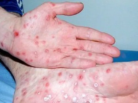 Thông tin nổi bật tại TPHCM ngày 4-5: Người mắc bệnh giang mai tăng; mở rộng đường Trần Bình Trọng